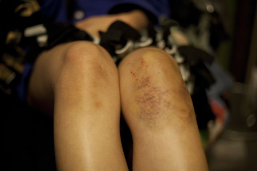 Epic bruise on my left knee.